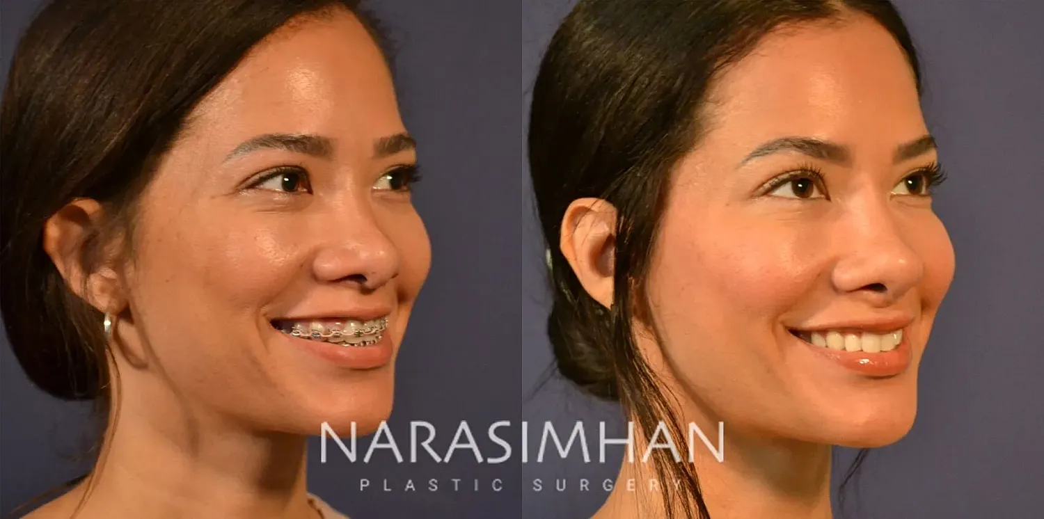 Rhinoplasty Before & After