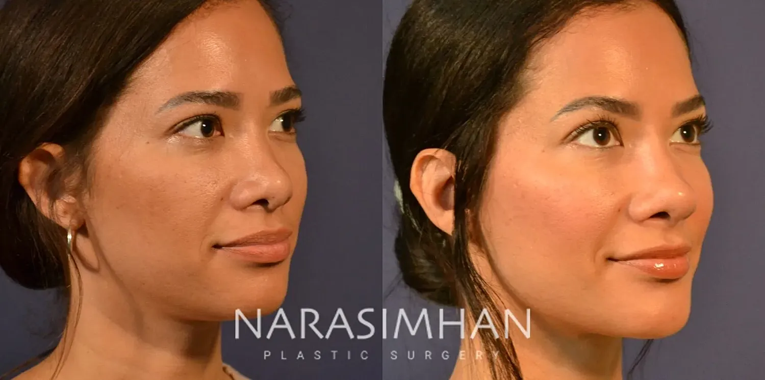 Rhinoplasty Before & After
