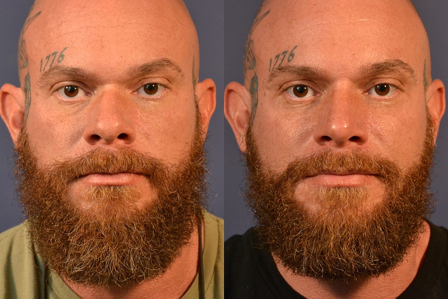 Rhinoplasty Before & After