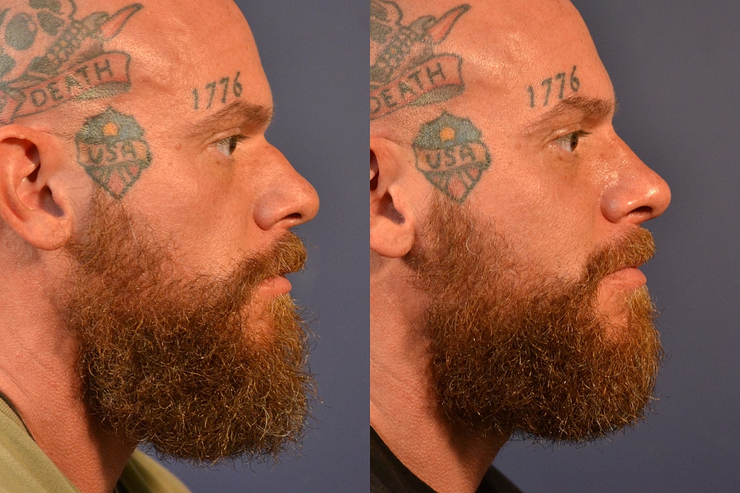 Rhinoplasty Before & After