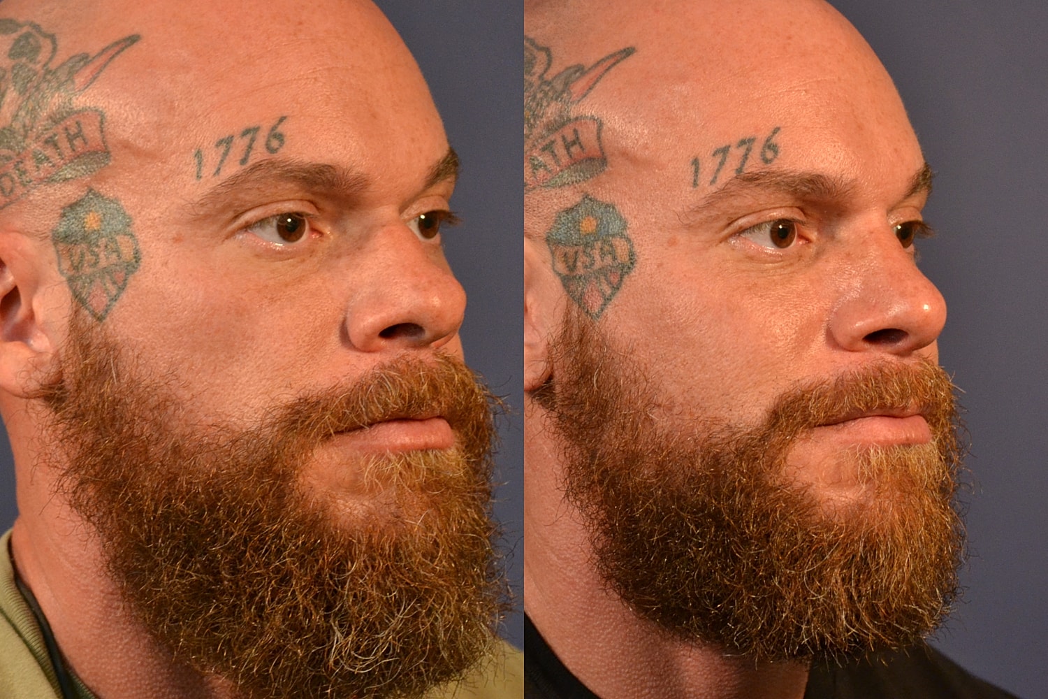 Rhinoplasty Before & After