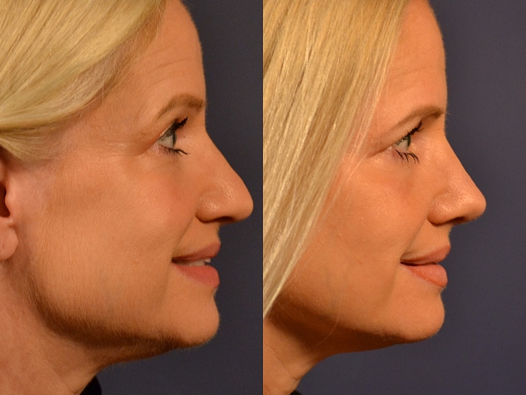 Before and after profile views of a woman.