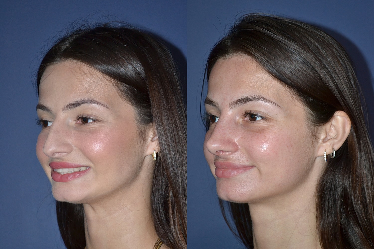 Rhinoplasty Before & After