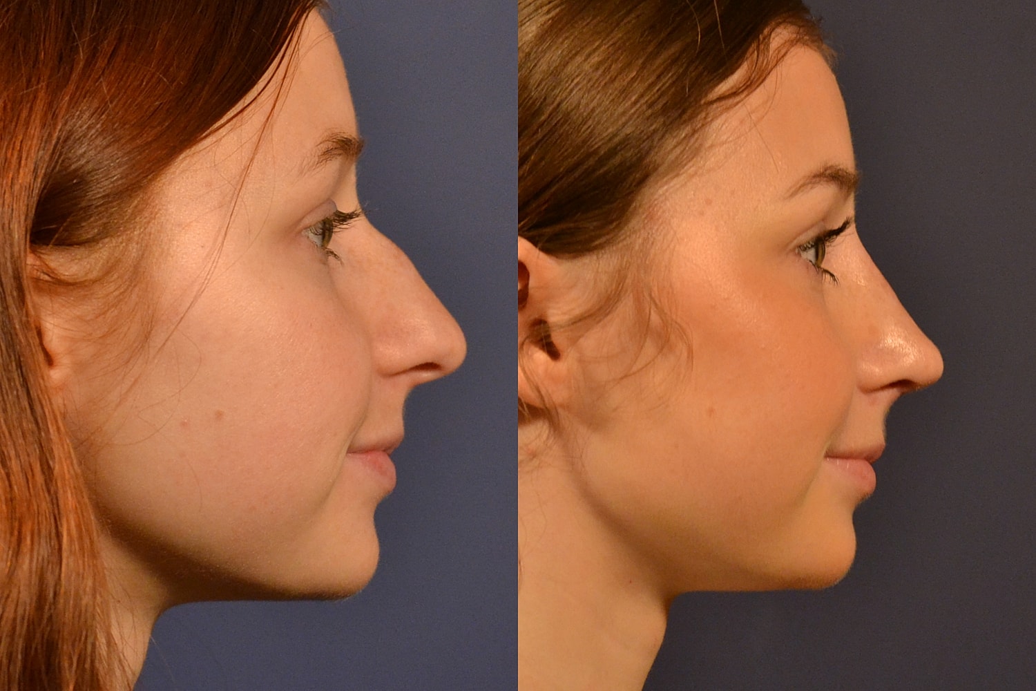 Rhinoplasty Before & After