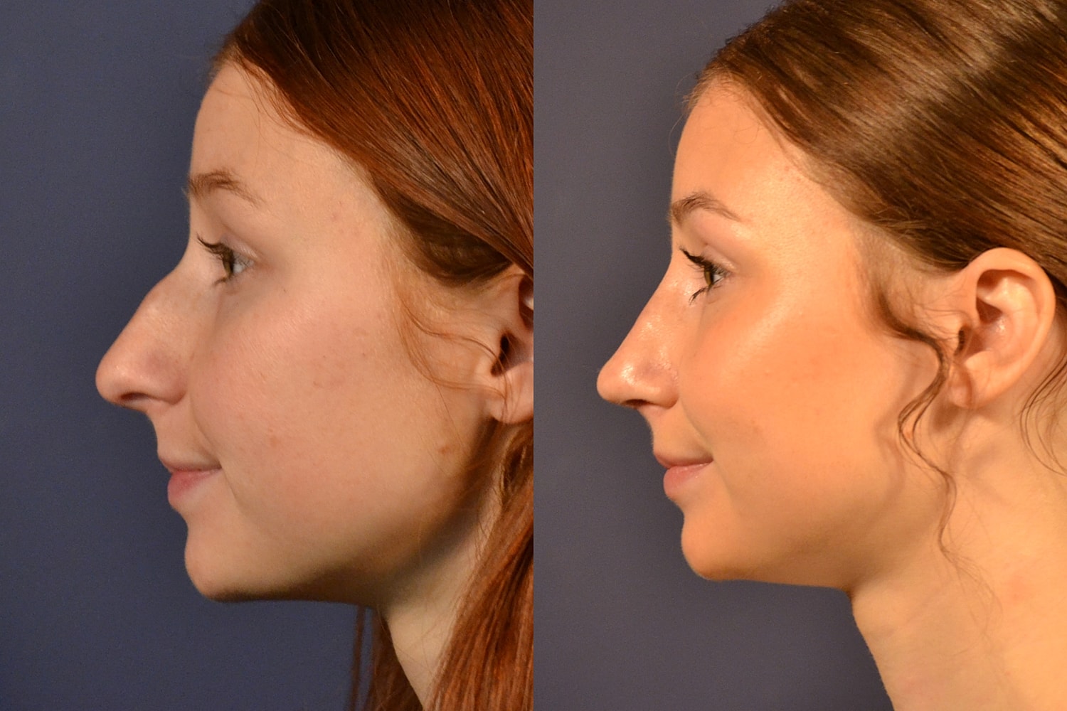 Rhinoplasty Before & After