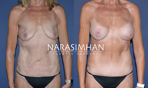 Breast Enhancement Before & After
