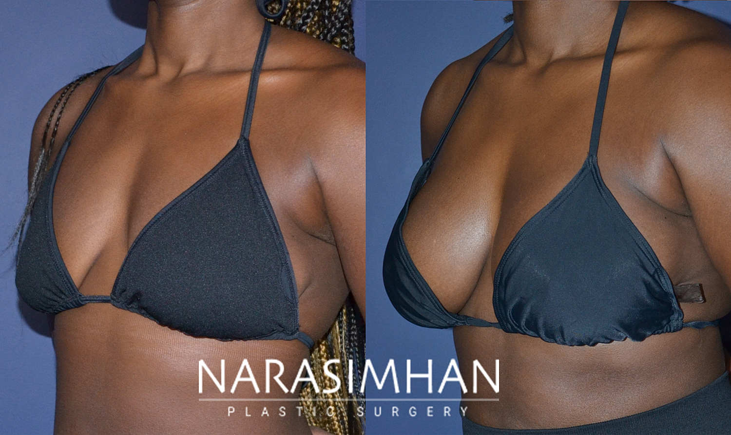 Breast Enhancement Before & After