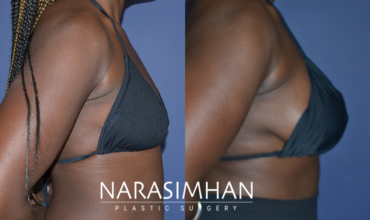 Breast Enhancement Before & After
