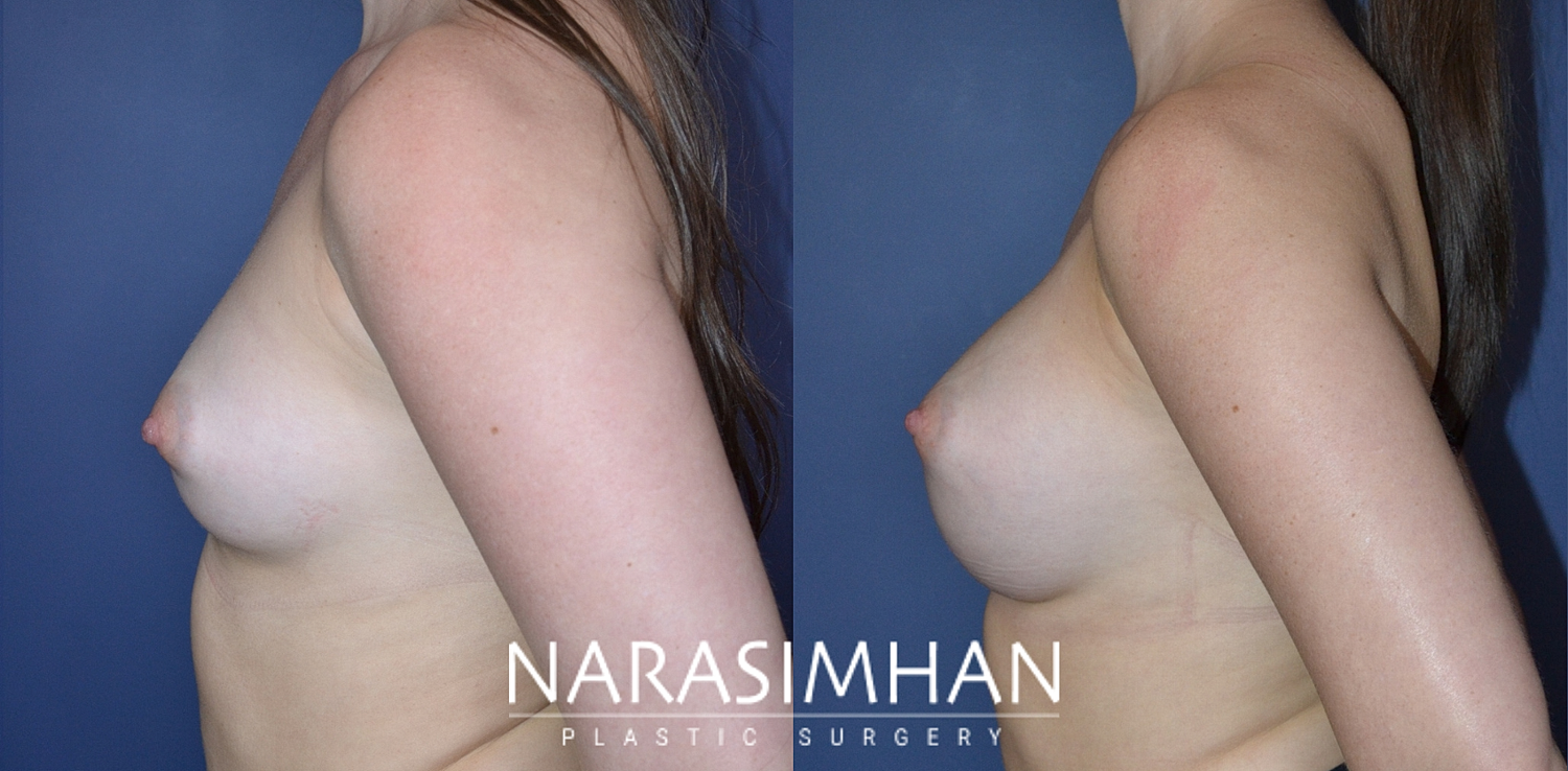 Breast Enhancement Before & After