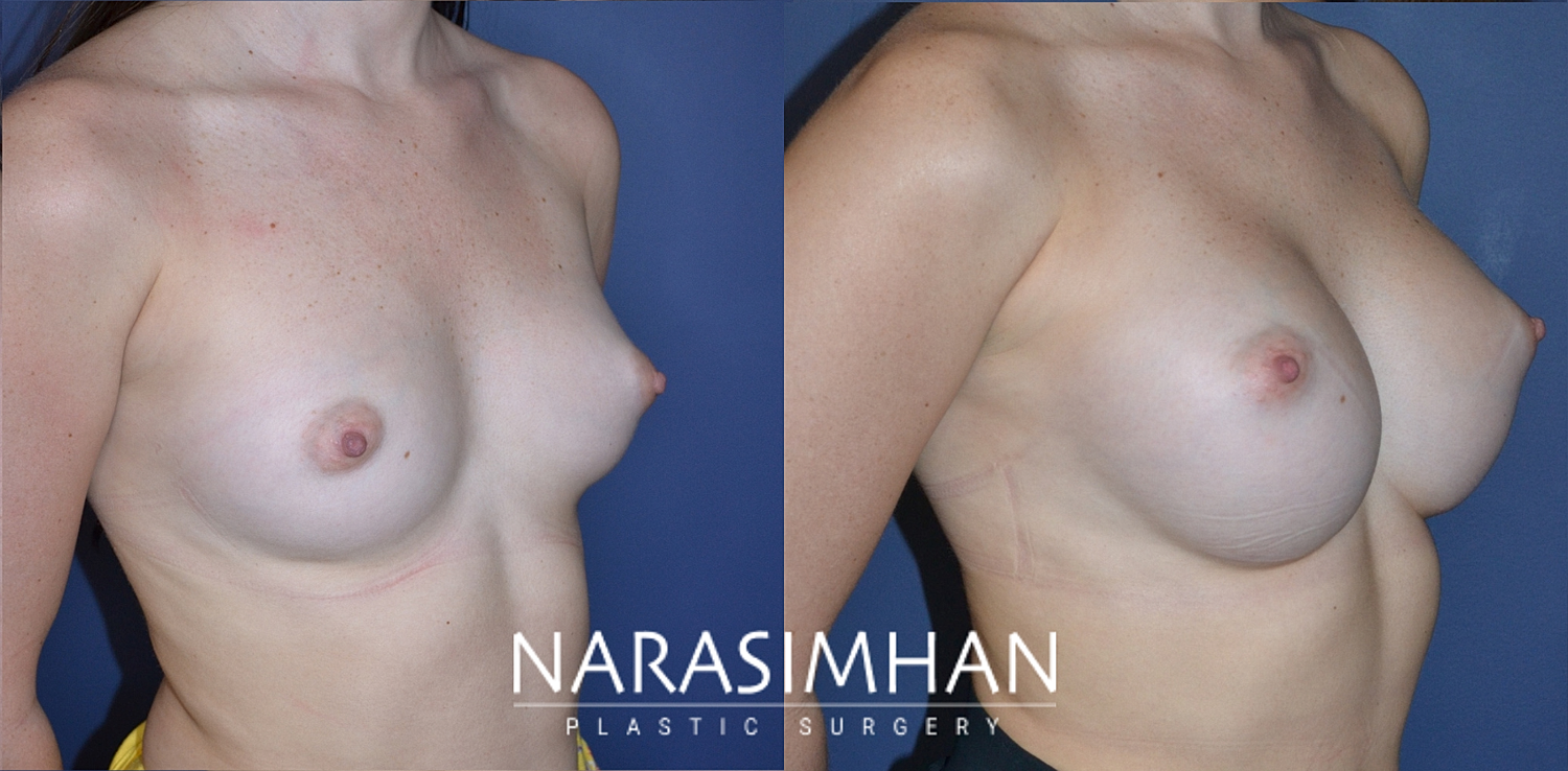 Breast Enhancement Before & After