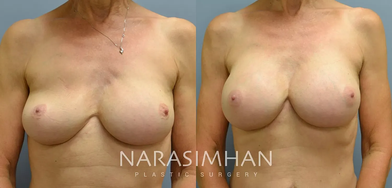 Breast Enhancement Before & After
