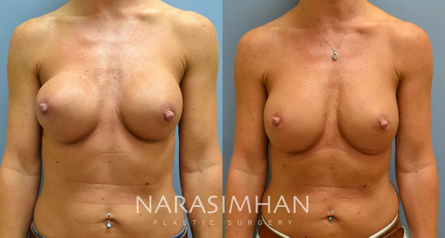 Breast Enhancement Before & After