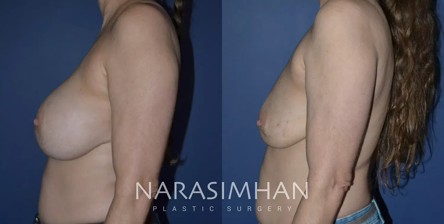 Breast Enhancement Before & After