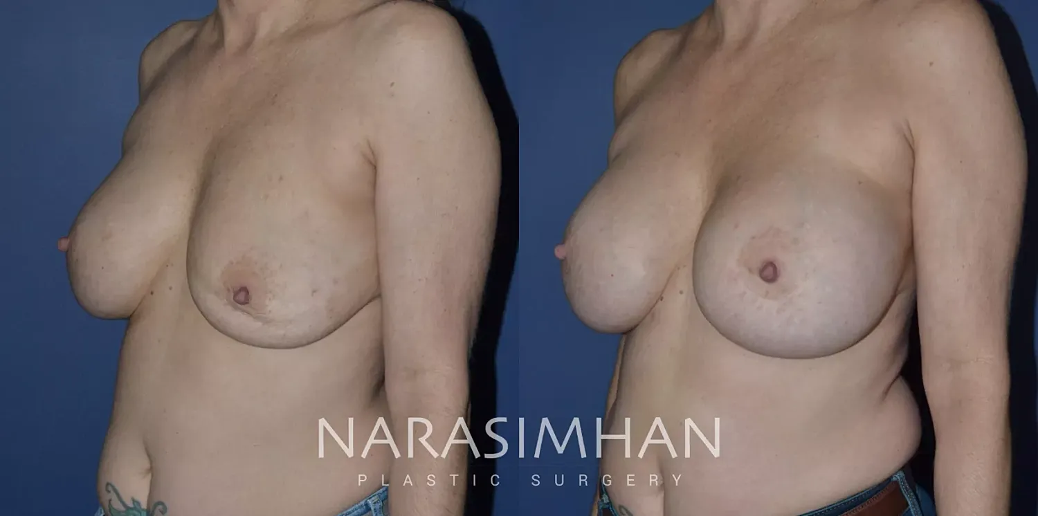 Breast Enhancement Before & After