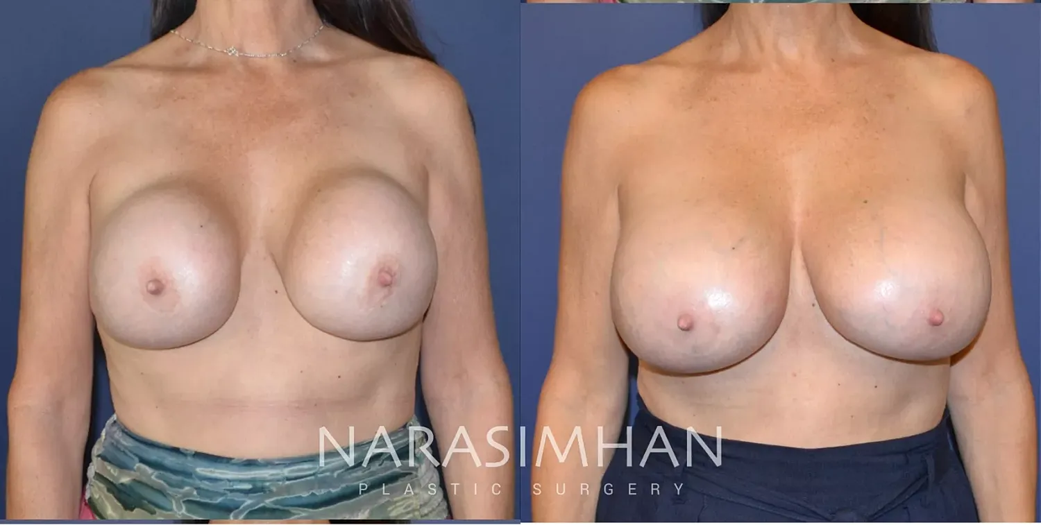 Breast Enhancement Before & After