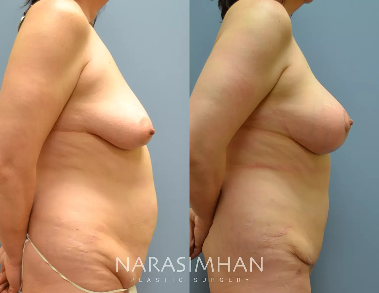 Breast Enhancement Before & After