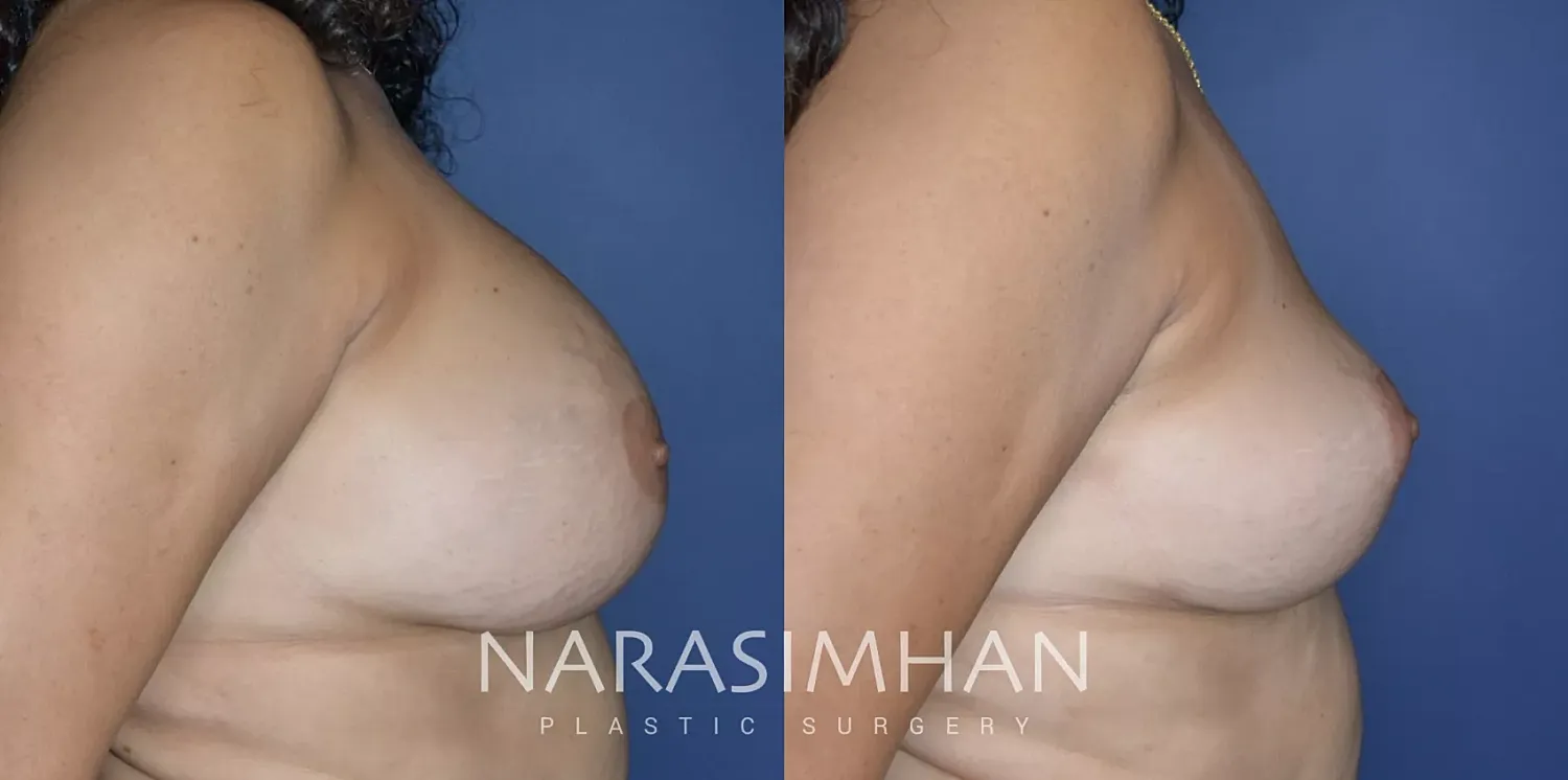 Breast Enhancement Before & After