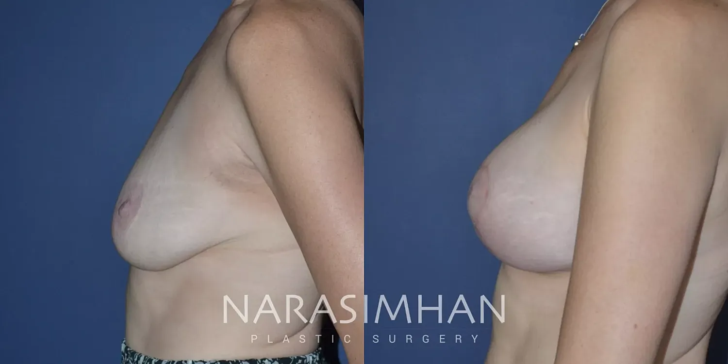 Breast Enhancement Before & After