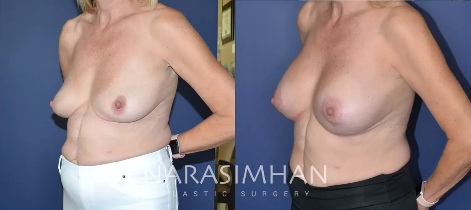 Breast Enhancement Before & After