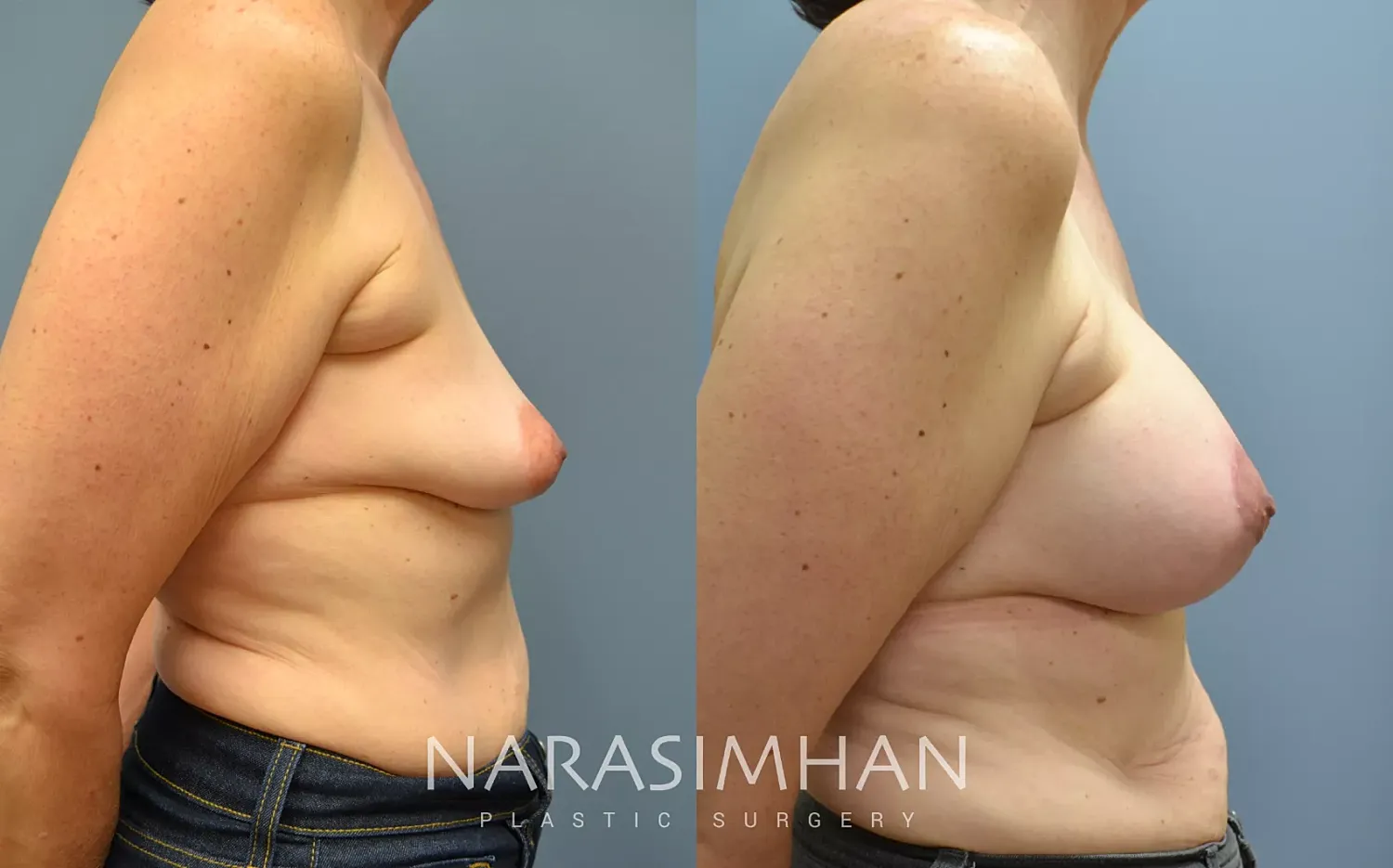 Breast Enhancement Before & After