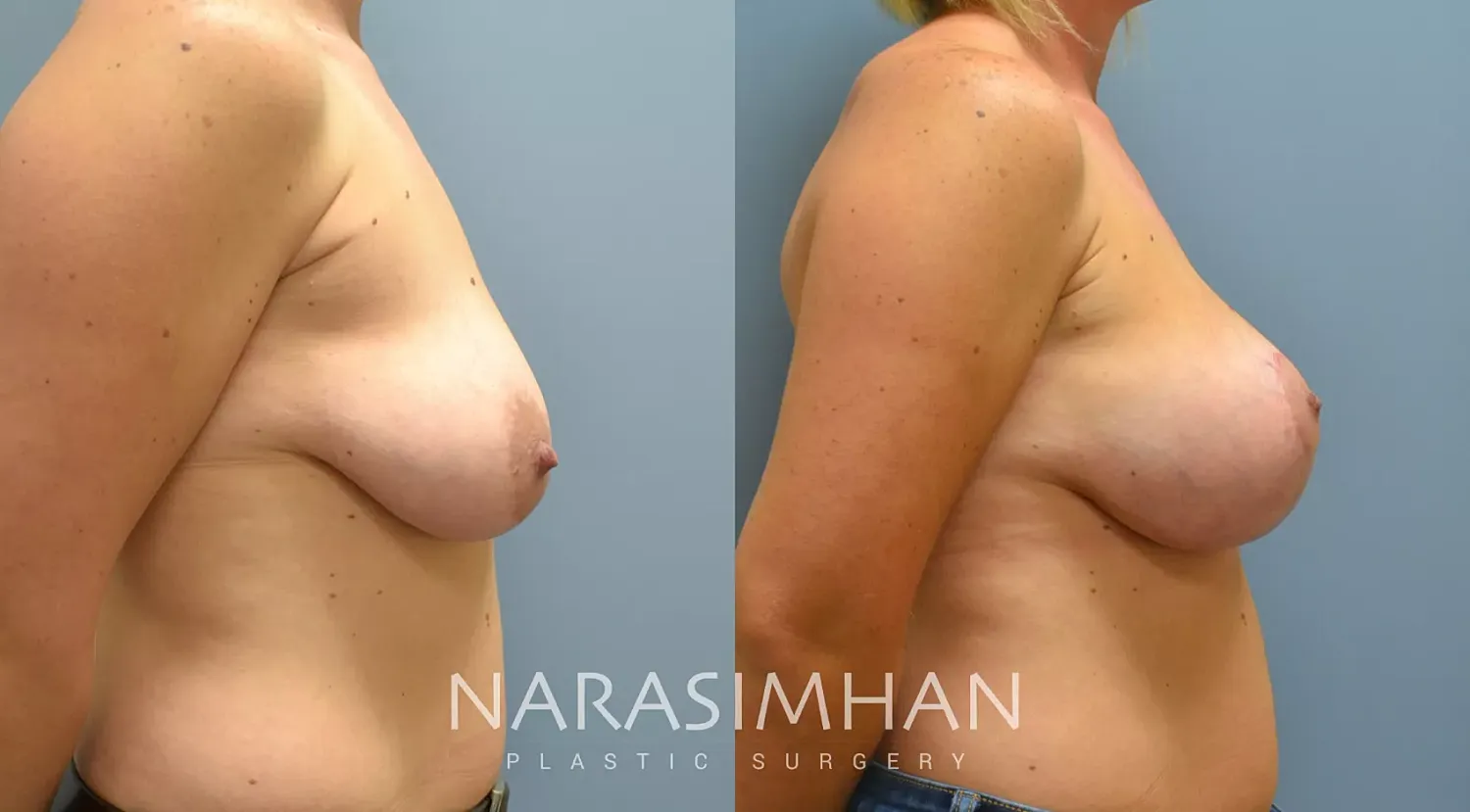 Breast Enhancement Before & After