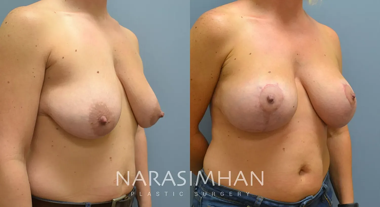 Breast Enhancement Before & After