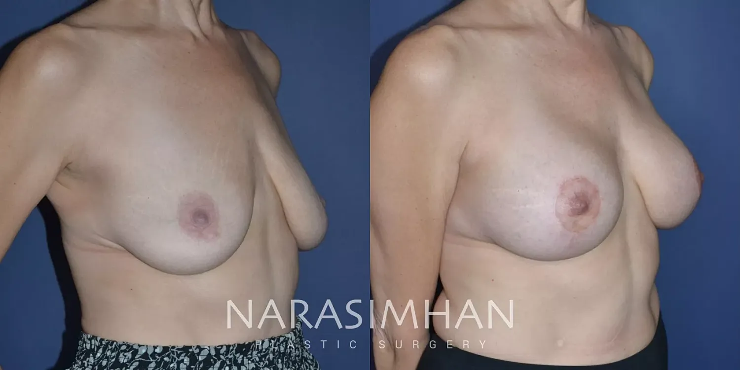 Breast Enhancement Before & After