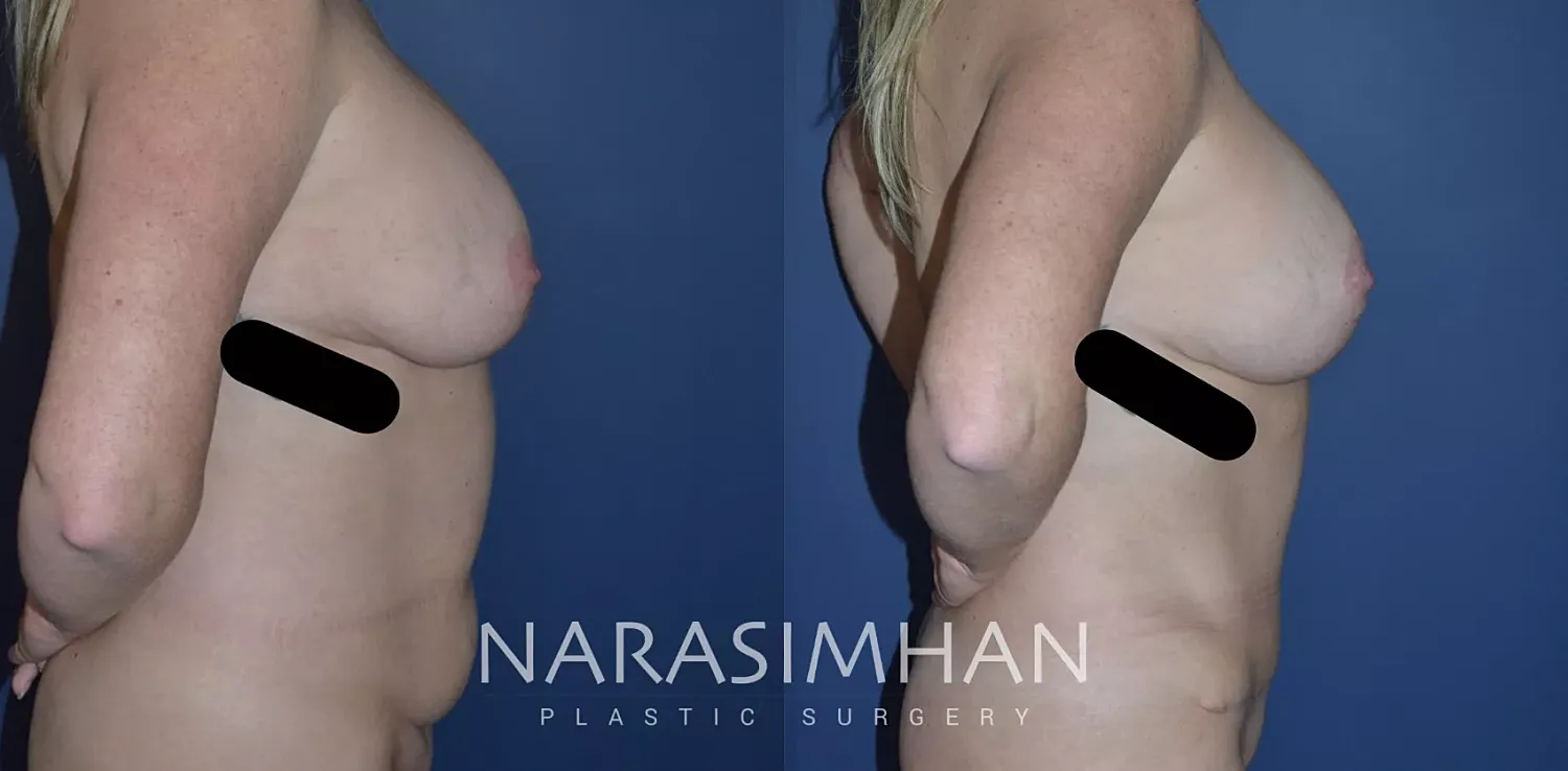 Breast Enhancement Before & After