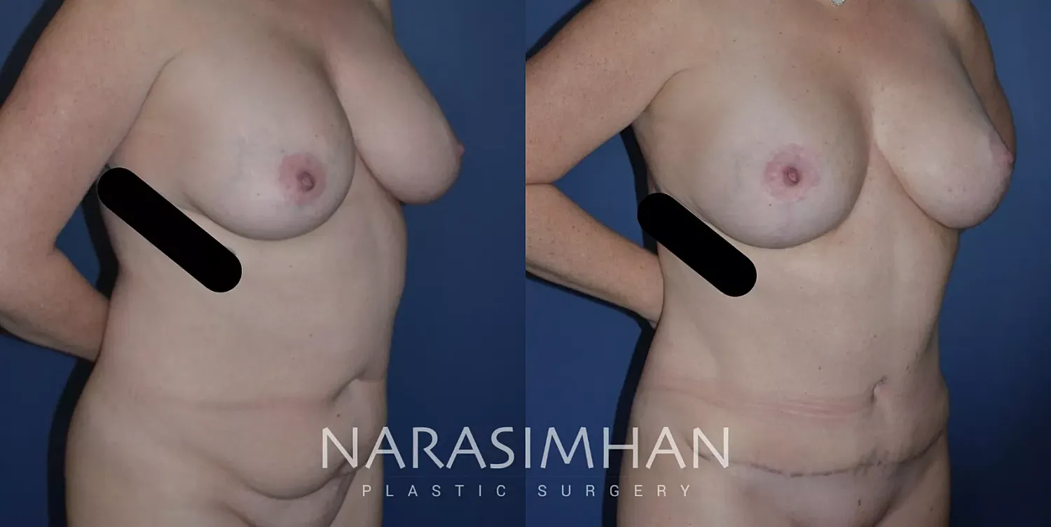 Breast Enhancement Before & After