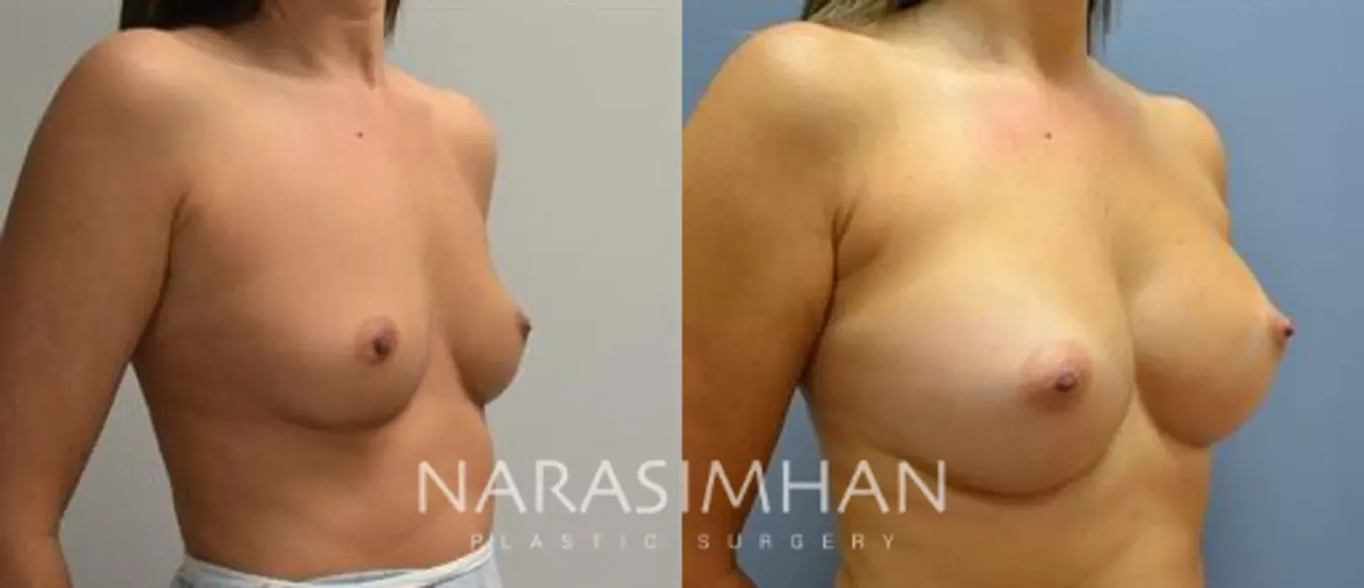Breast Enhancement Before & After