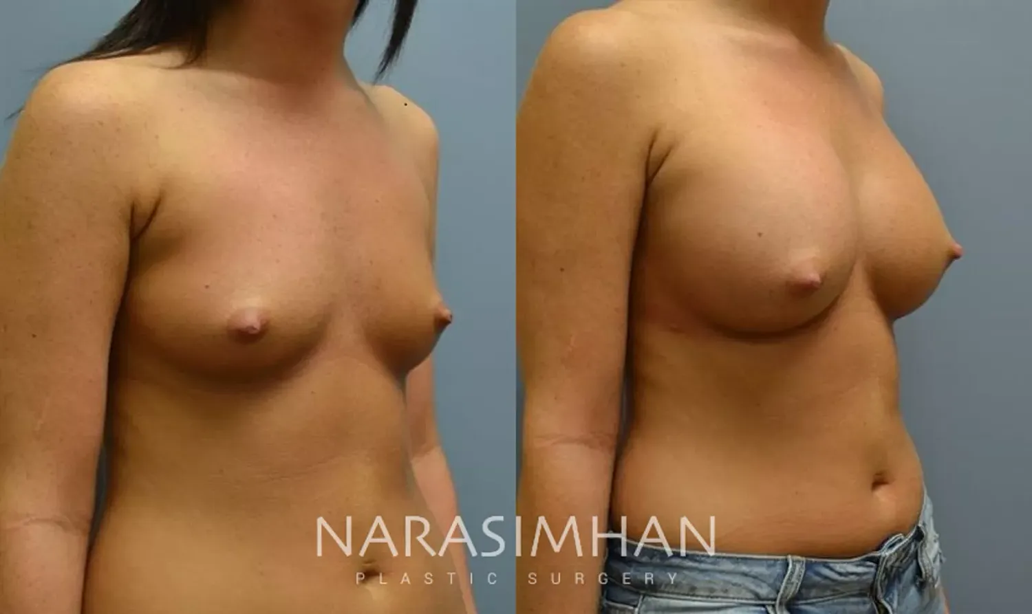 Breast Enhancement Before & After