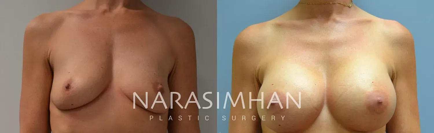 Breast Enhancement Before & After