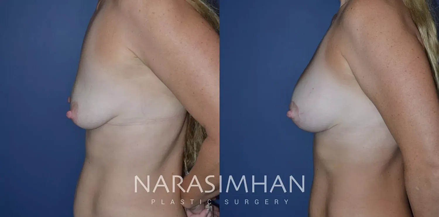 Breast Enhancement Before & After