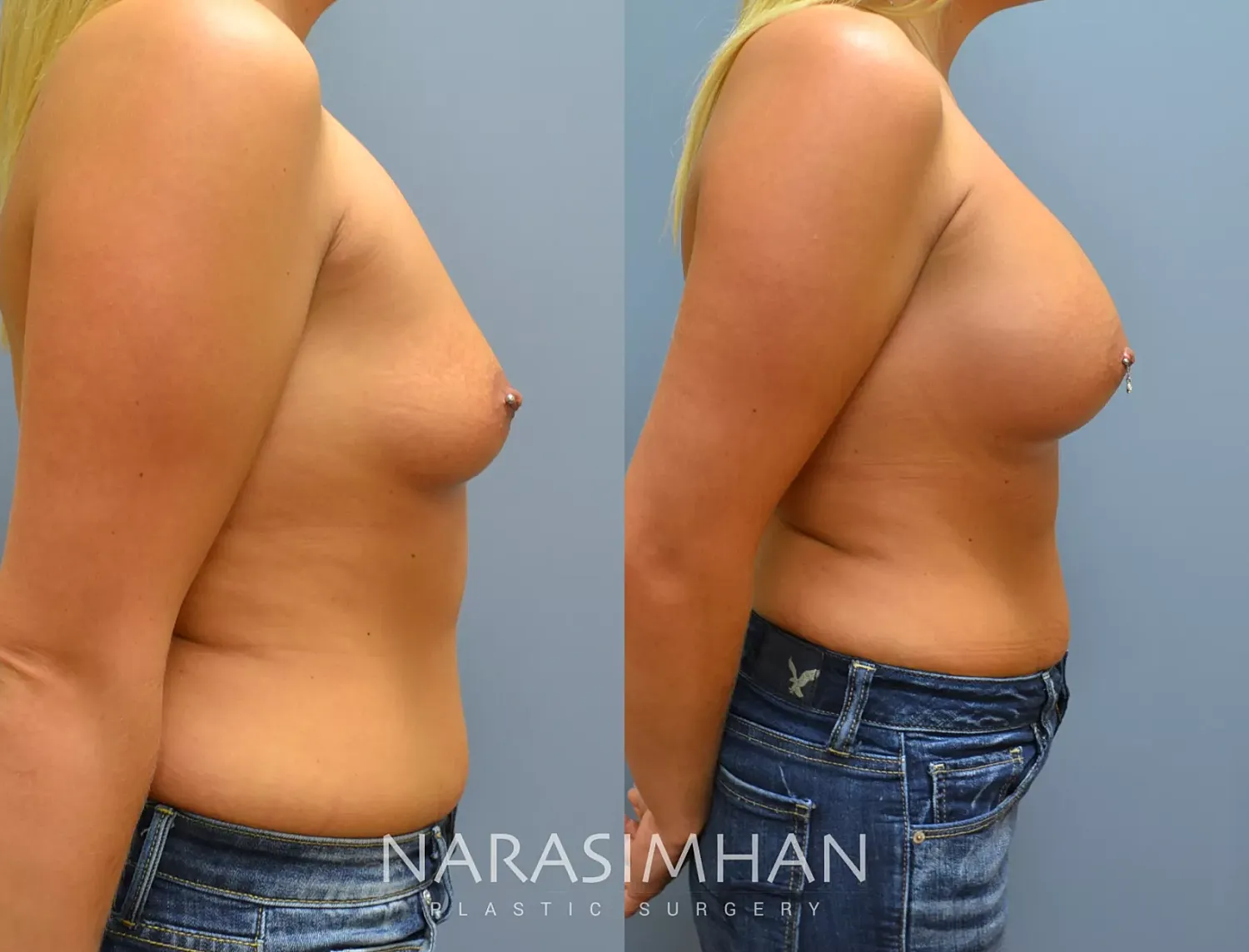 Breast Enhancement Before & After