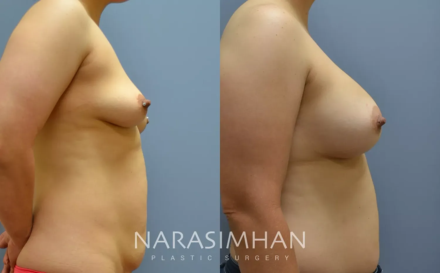 Breast Enhancement Before & After