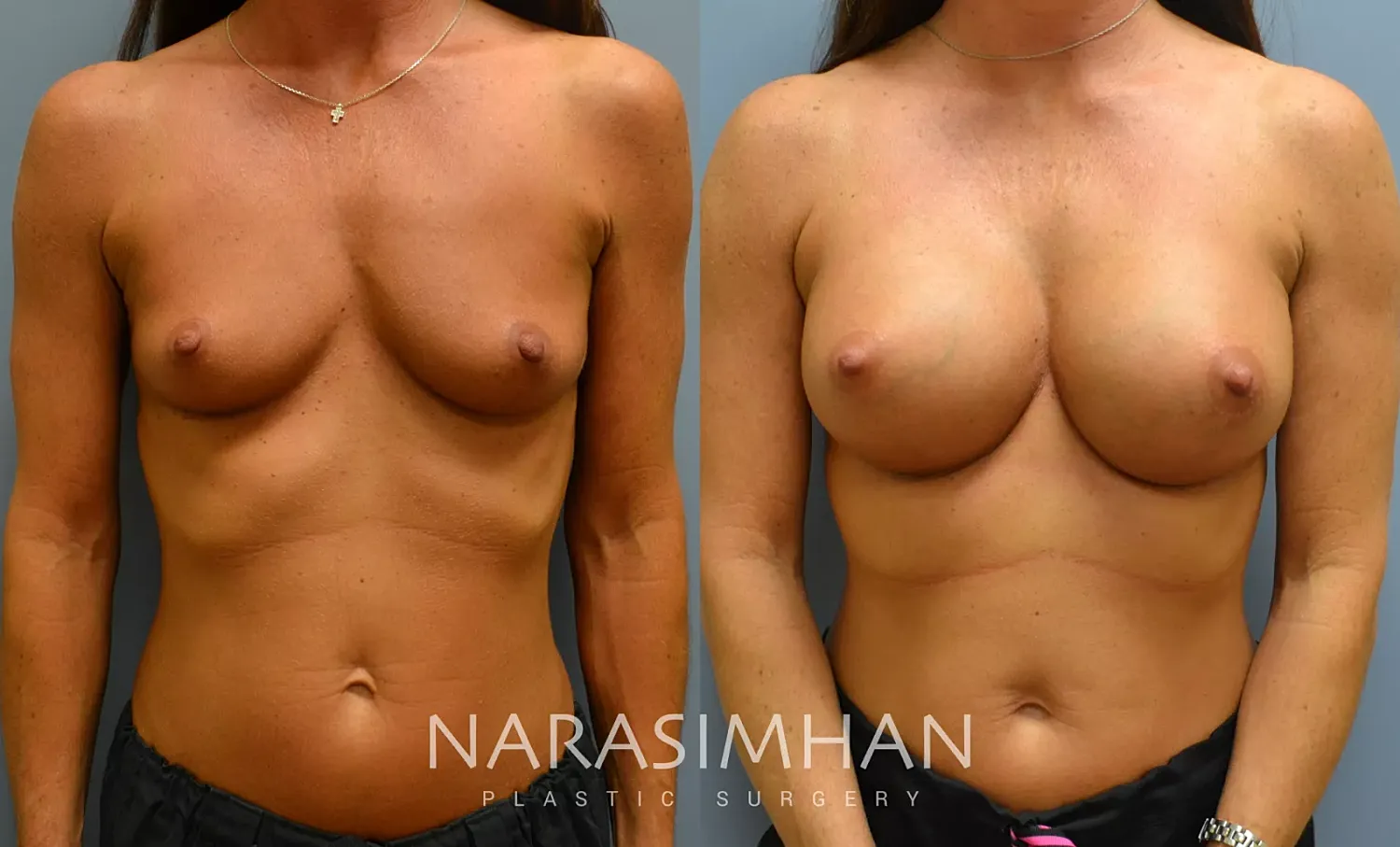 Breast Enhancement Before & After