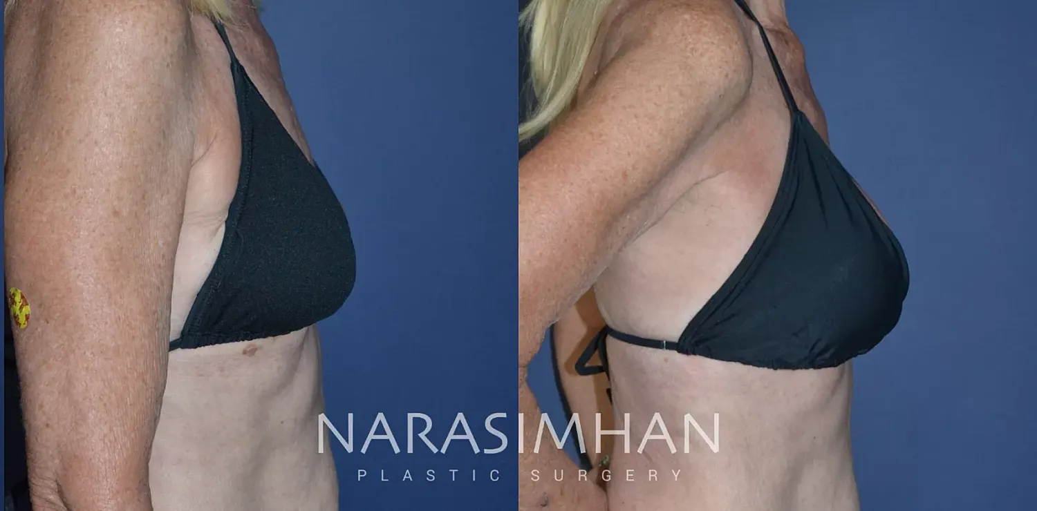 Breast Enhancement Before & After