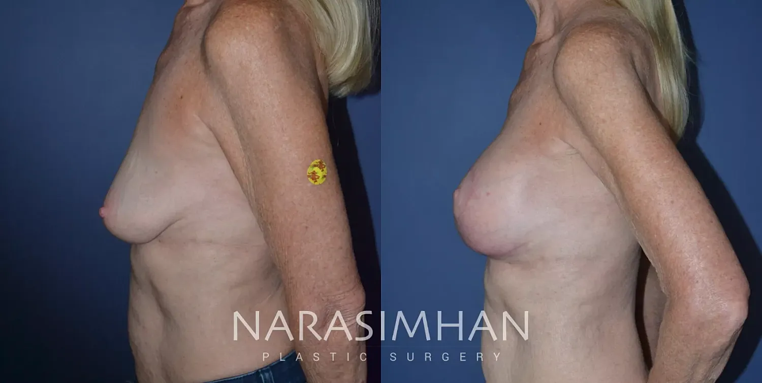 Breast Enhancement Before & After