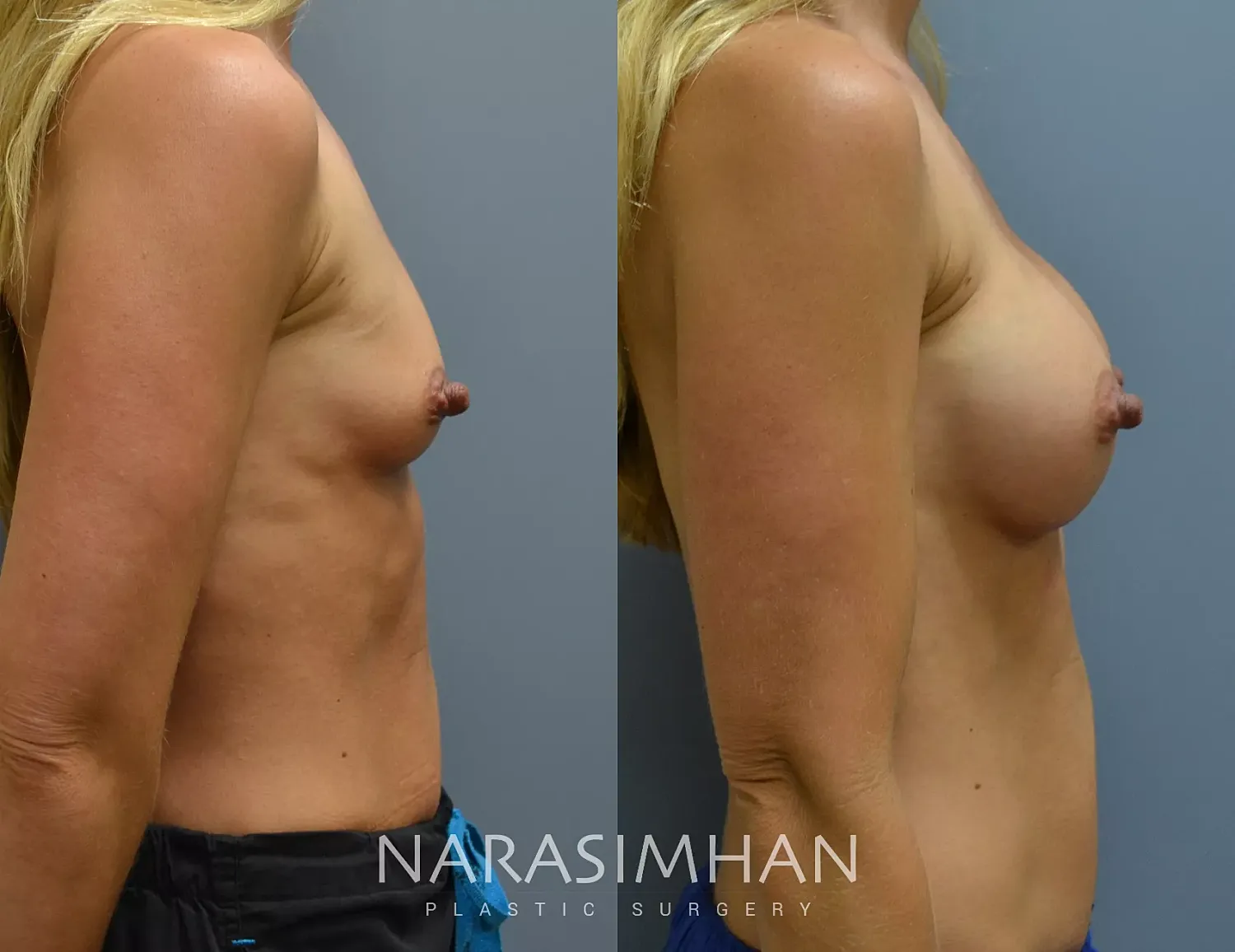 Breast Enhancement Before & After