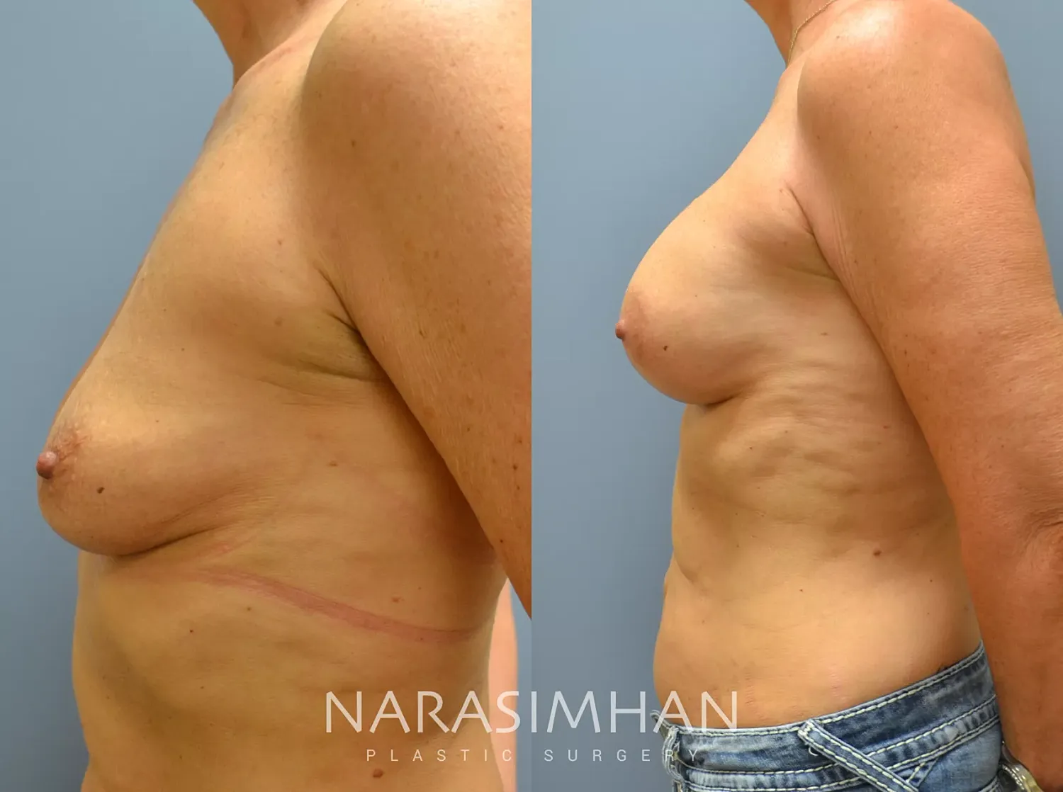 Breast Enhancement Before & After