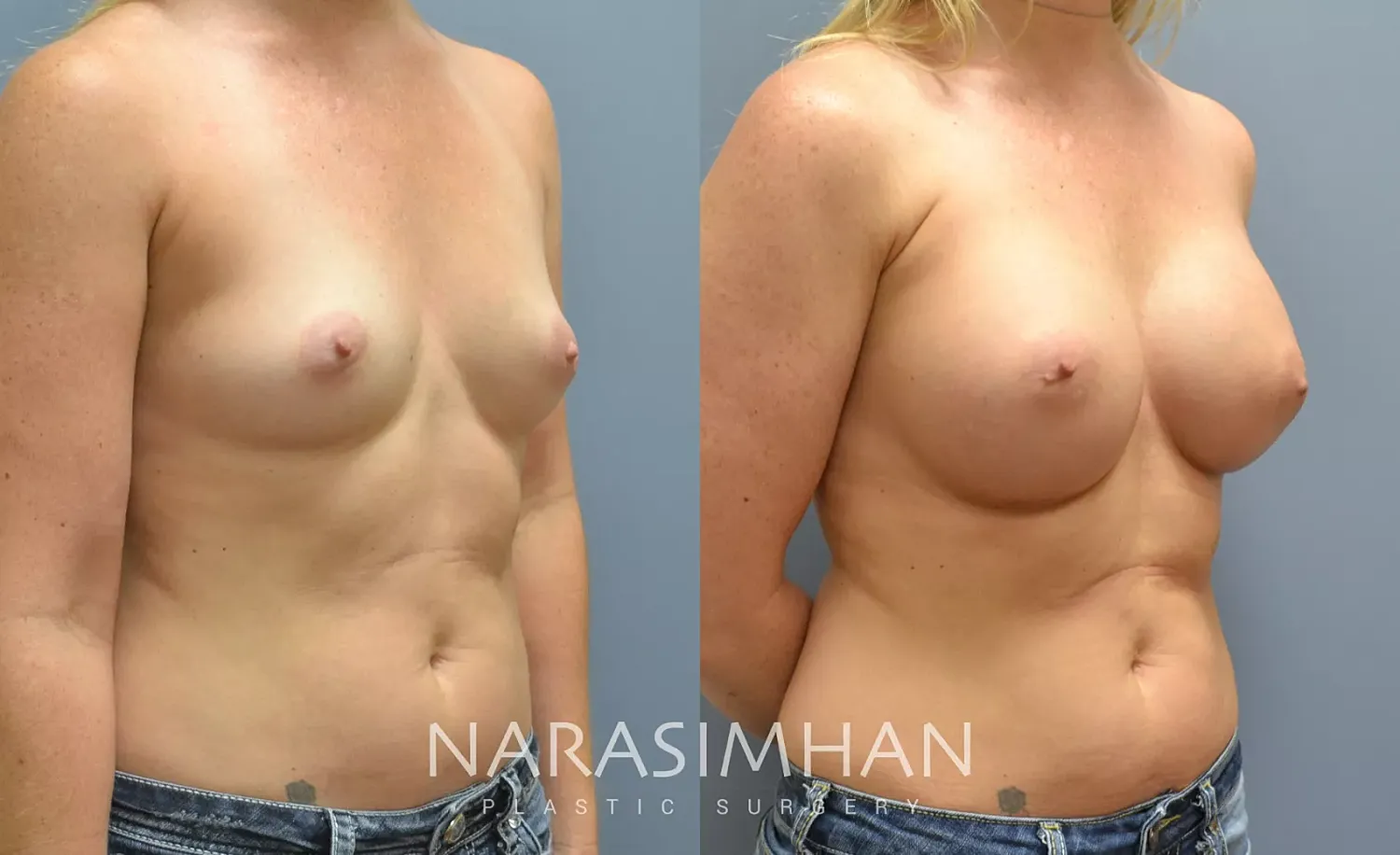 Breast Enhancement Before & After