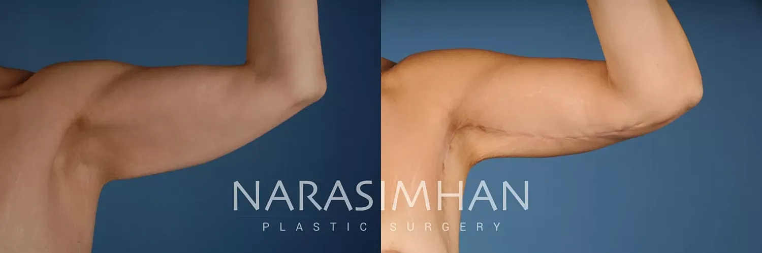 Breast Enhancement Before & After