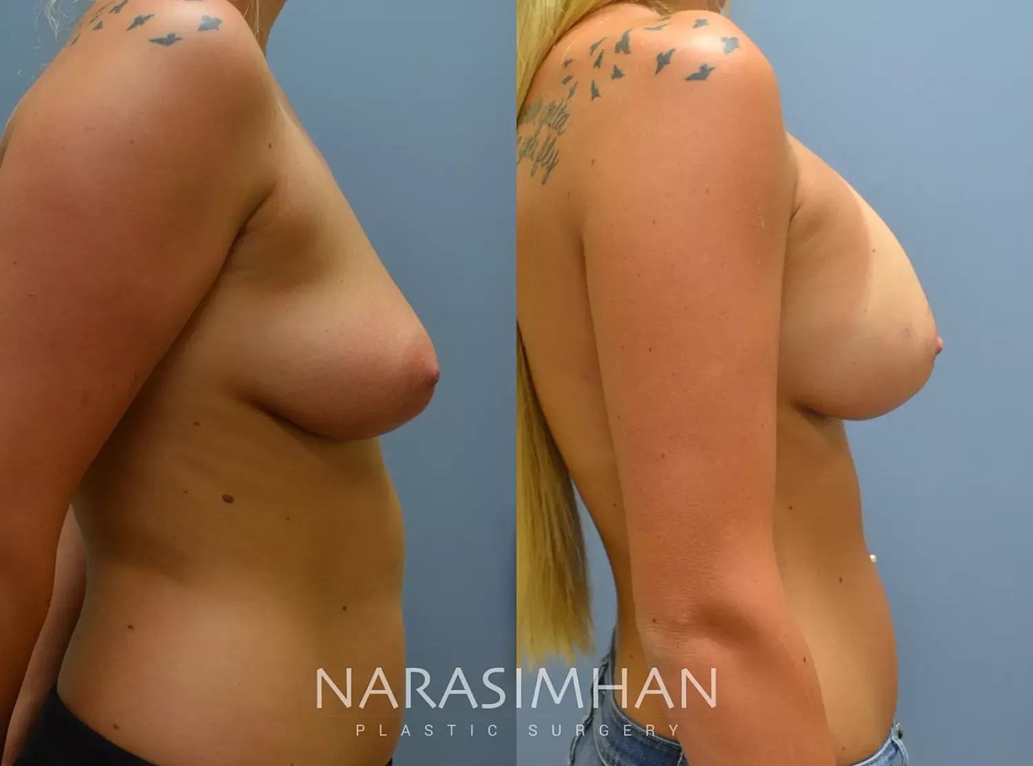 Breast Enhancement Before & After