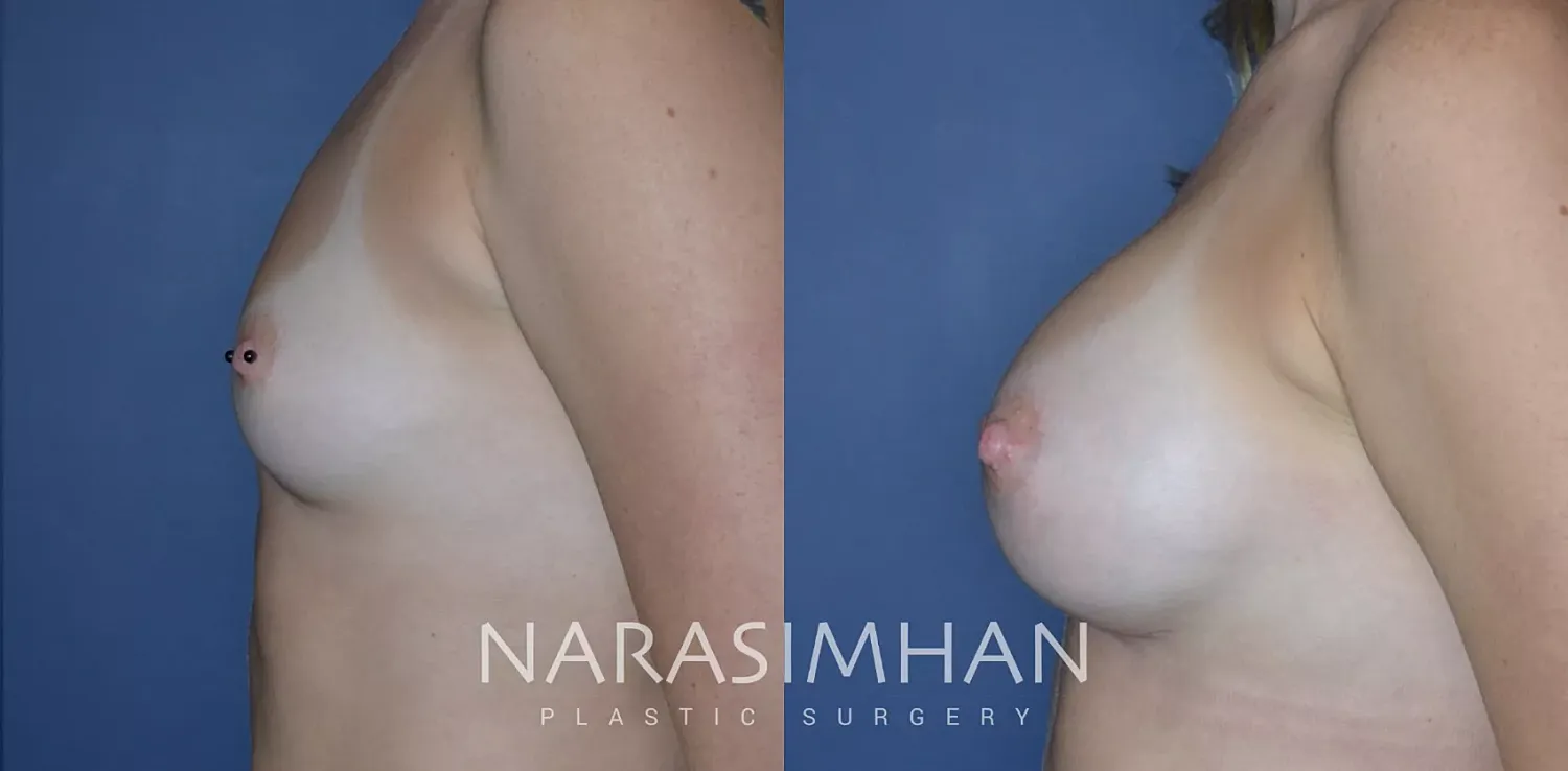 Breast Enhancement Before & After