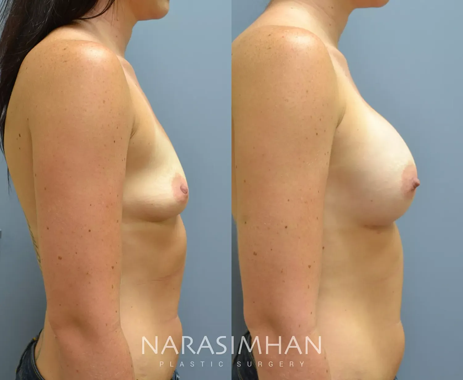 Breast Enhancement Before & After