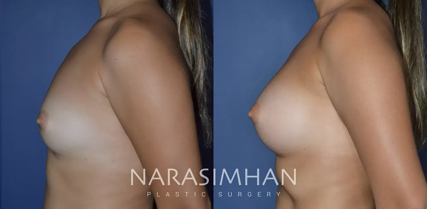 Breast Enhancement Before & After