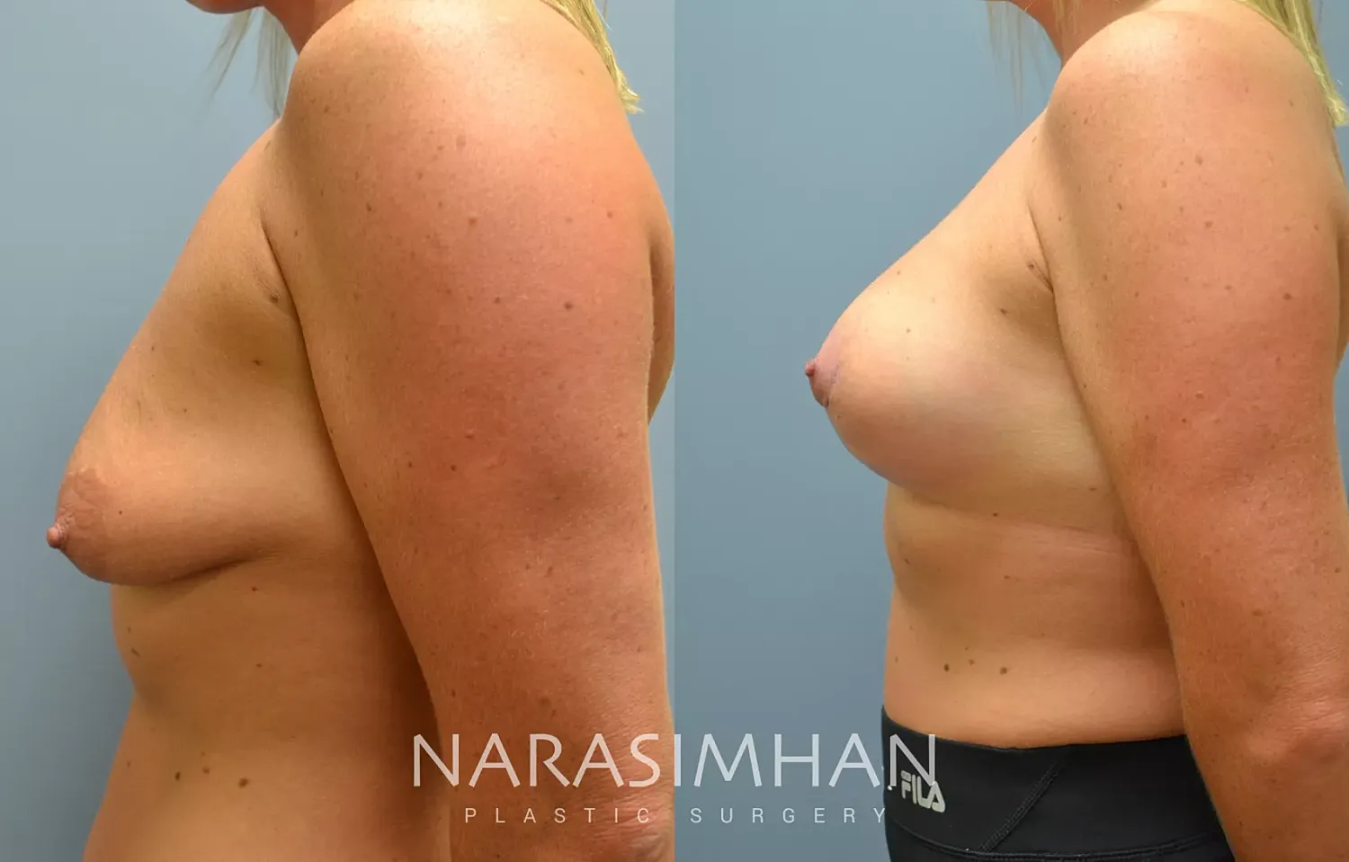 Breast Enhancement Before & After