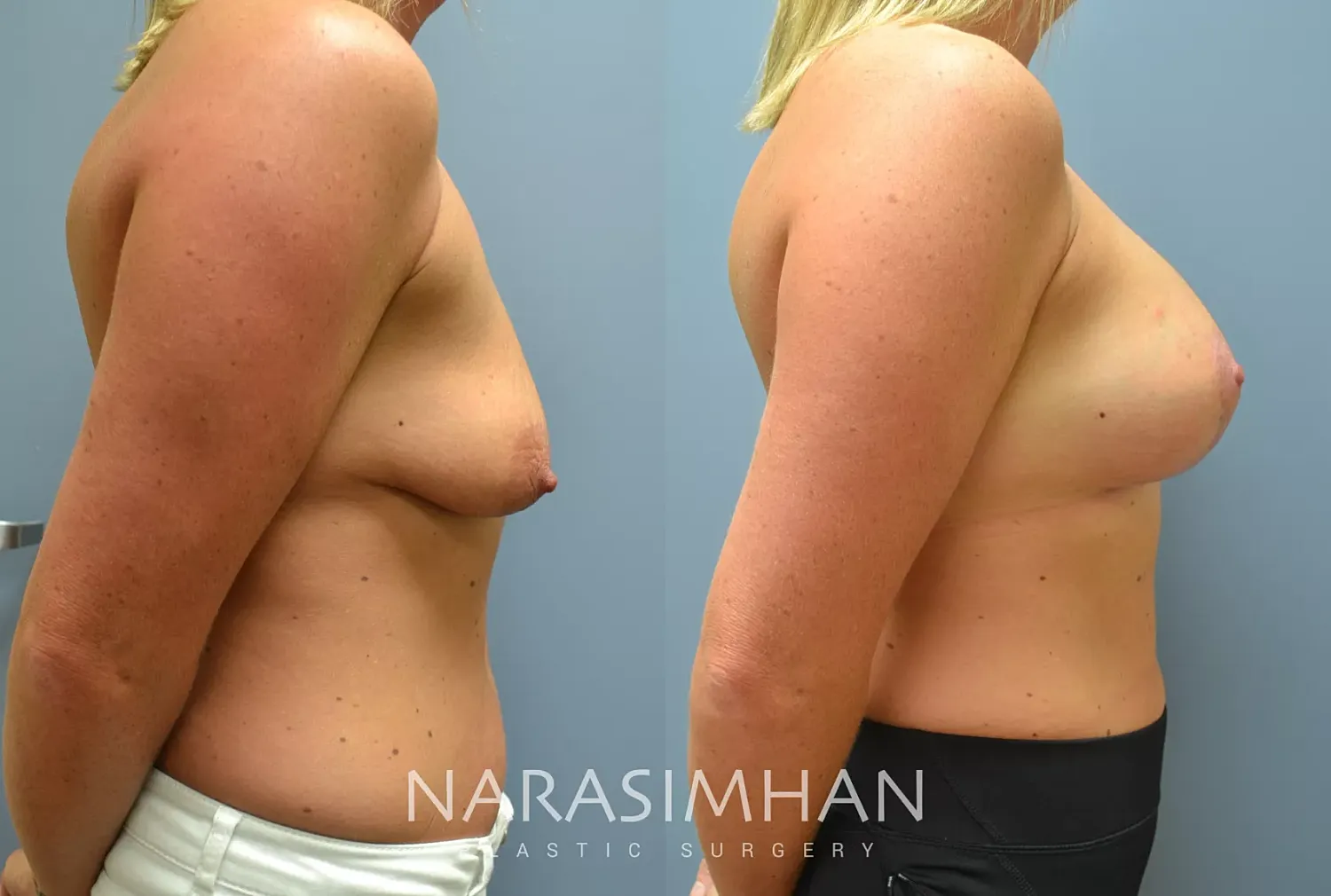 Breast Enhancement Before & After