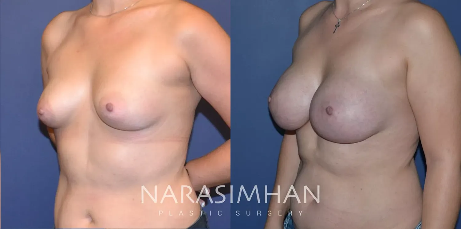 Breast Enhancement Before & After