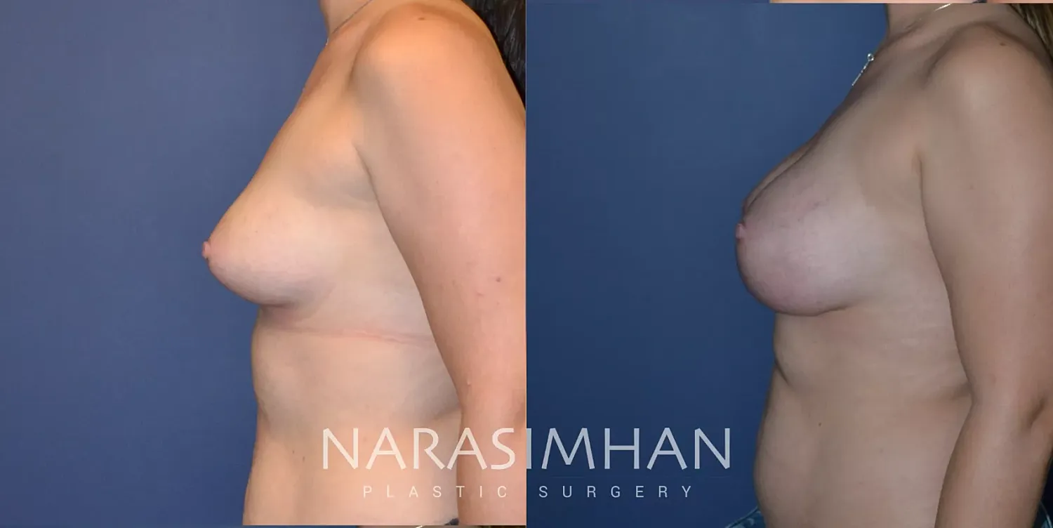 Breast Enhancement Before & After